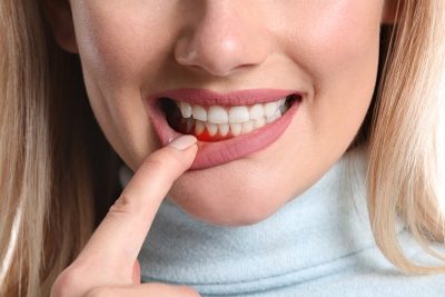 Gum Disease with Proper Nutrition
