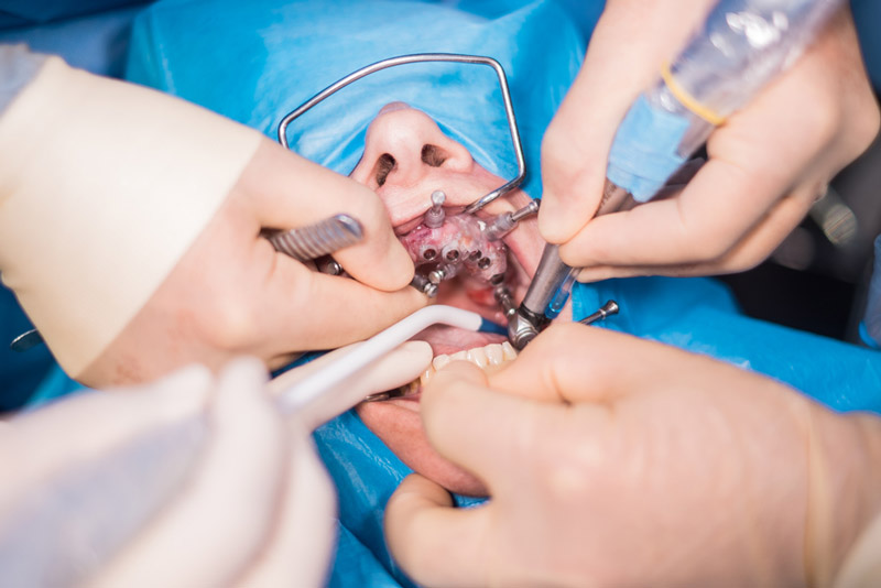 Minor and Major Dental Surgery Procedure