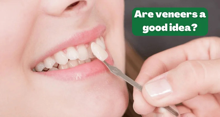 Are Veneers a Good Idea? Pros and Cons Explained