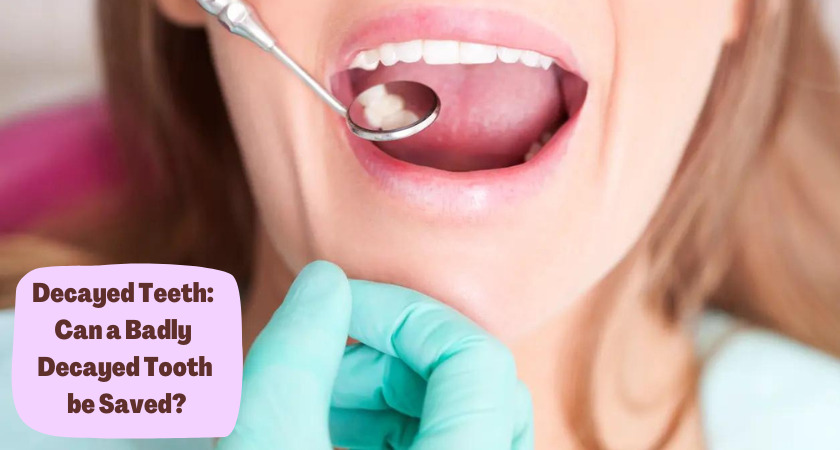 Decayed Teeth: Can a Badly Decayed Tooth Be Saved?