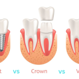 Veneers vs Crowns vs Implants