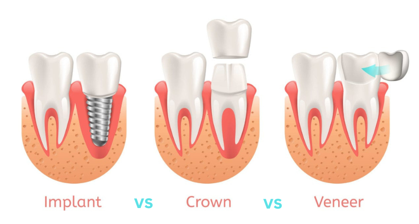 Veneers vs Crowns vs Implants: Everything You Need to Know!
