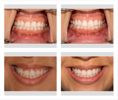 Laser gum lift and veneers: before-after