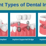 Different types of dental implants