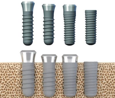 Types of dental implants materials