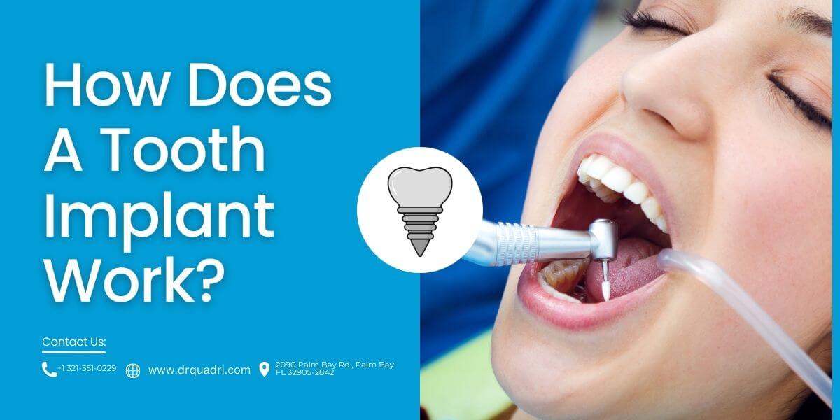 How Does A Tooth Implant Work?
