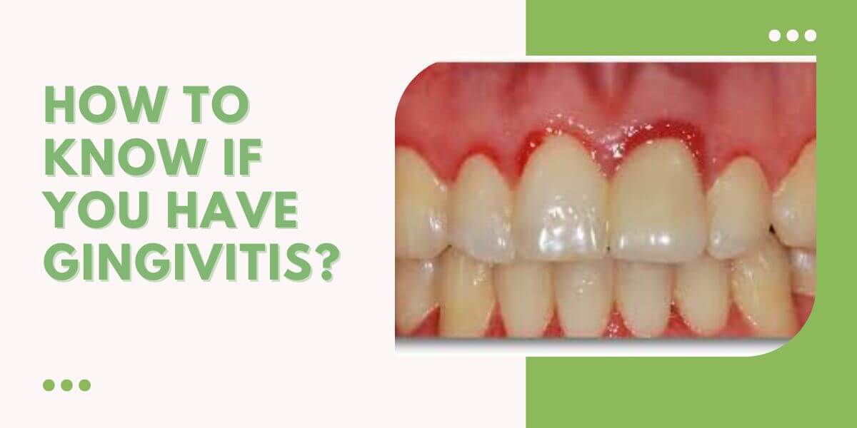 How To Know If You Have Gingivitis?