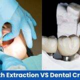 Tooth extraction vs crown