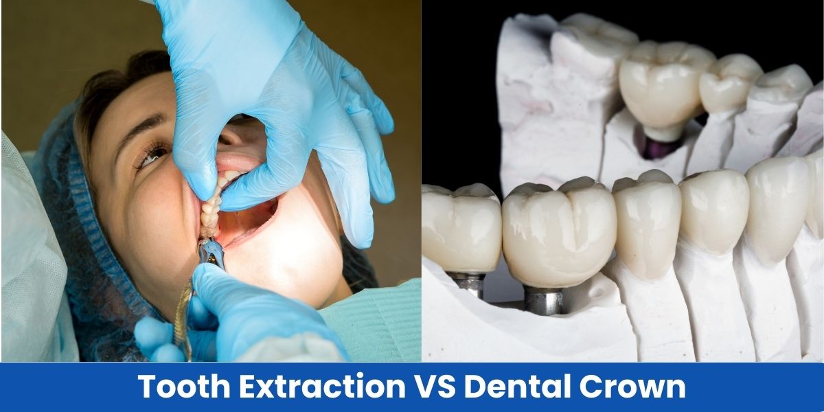 A Complete Recapitulation of Tooth Extraction vs Crown