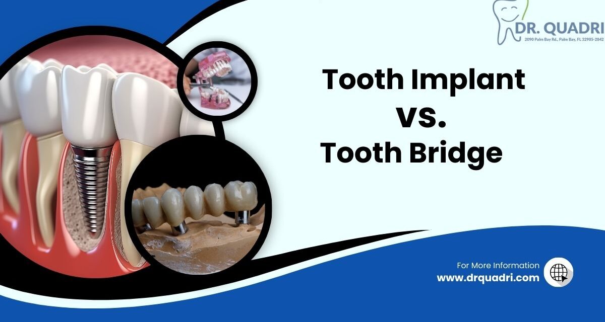 Tooth Implant or Bridge Which is Better Insights from Dr.Quadri