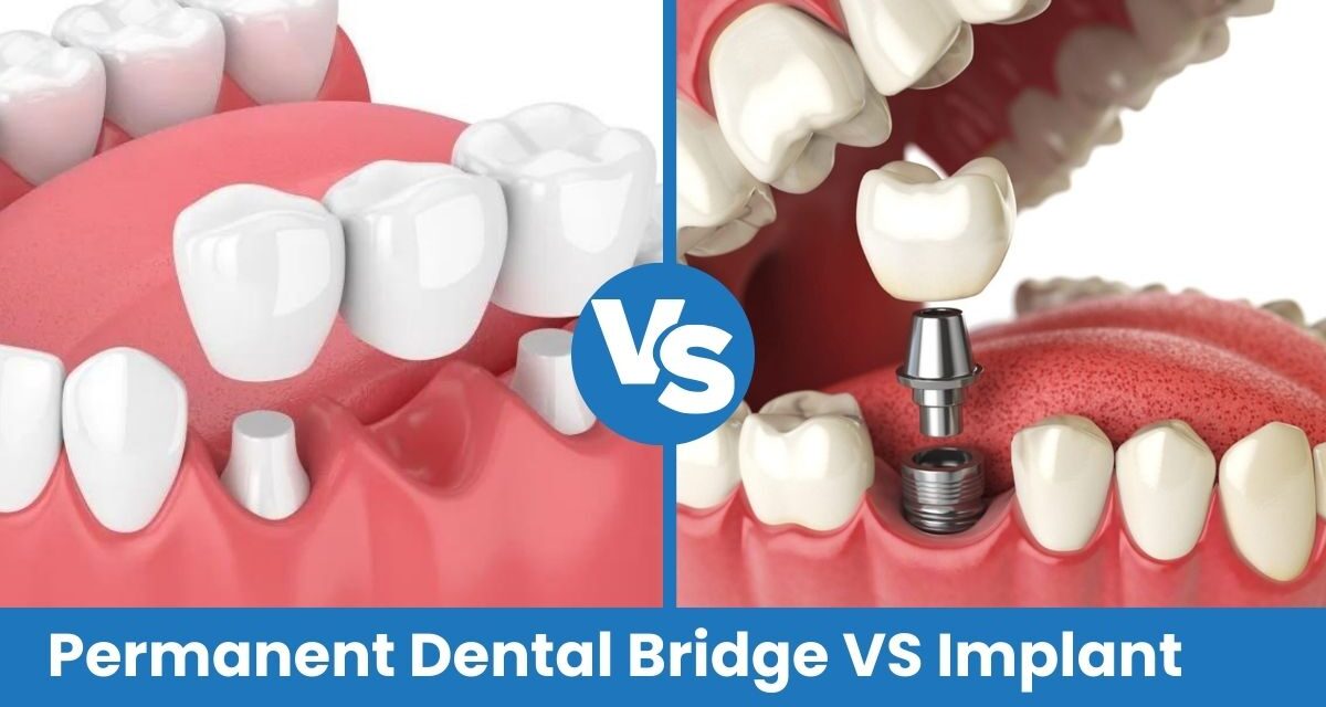 Permanent Dental Bridge vs Implant