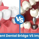 permanent dental bridge vs implant