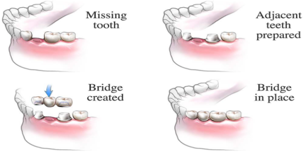 Permanent Dental Bridge