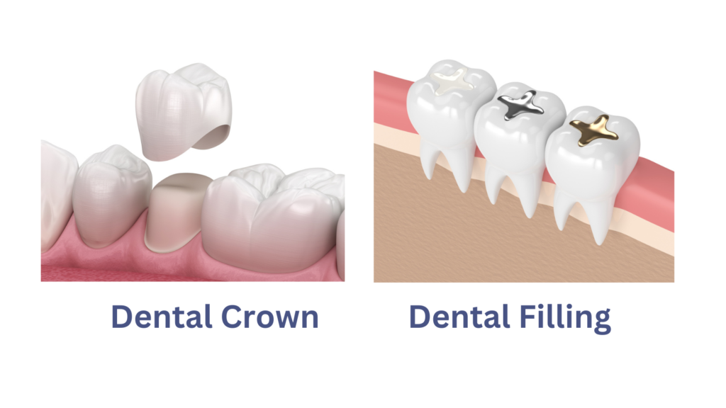 Tooth Crown vs Filling 